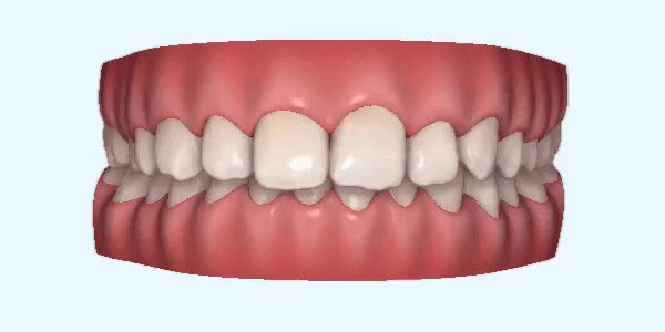 Invisalign - diepe beet
