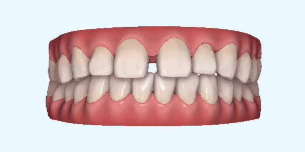 Invisalign tanden - gapende tanden