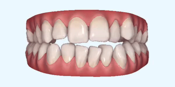 Invisalign tanden - open beet