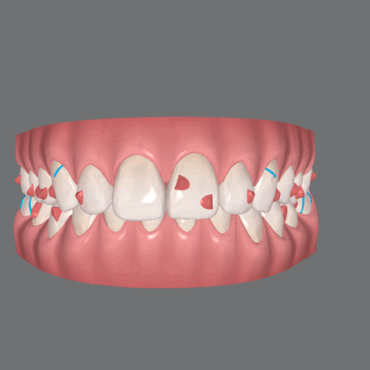 Invisalign