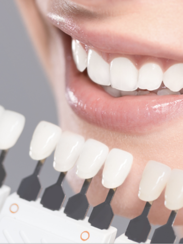 Veneers
