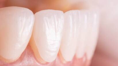 Veneers