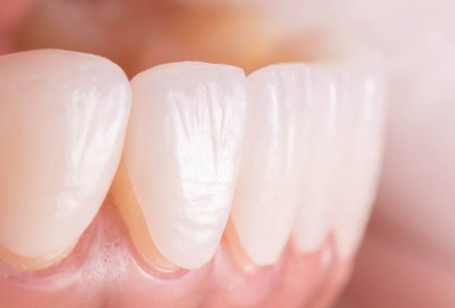 Veneers