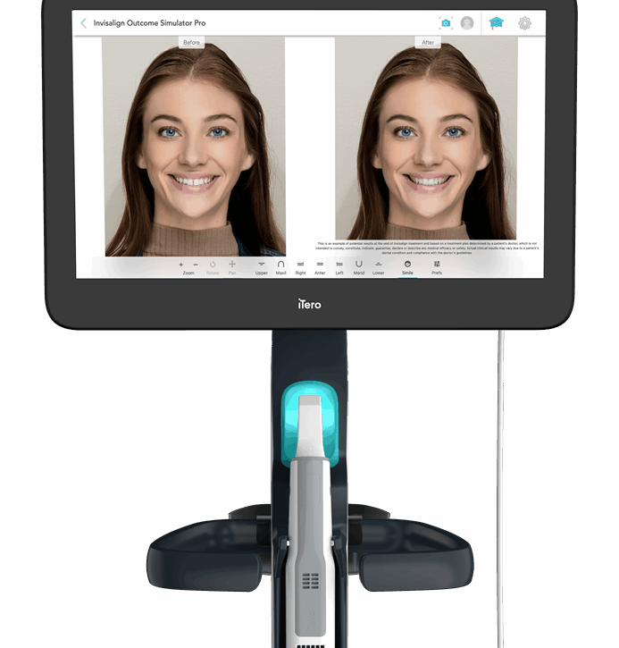 Invisalign Outcome Simulator